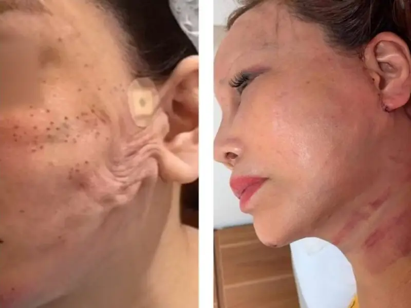 Tay nghề bác sĩ non kém có thể gây sẹo trên da mặt khách hàng