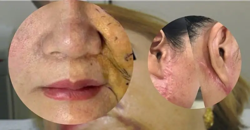 Gương mặt có nguy cơ nhiễm trùng sau căng chỉ