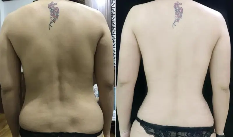Hút mỡ lưng giúp khách hàng sở hữu tấm lưng thon gọn, săn chắc và quyến rũ
