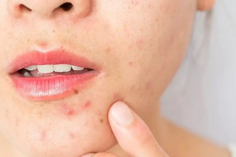 Dùng sản phẩm chăm sóc da không phù hợp sau khi triệt lông gây mụn