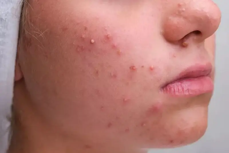 Nổi mụn sau khi triệt lông mặt do mất lớp sừng