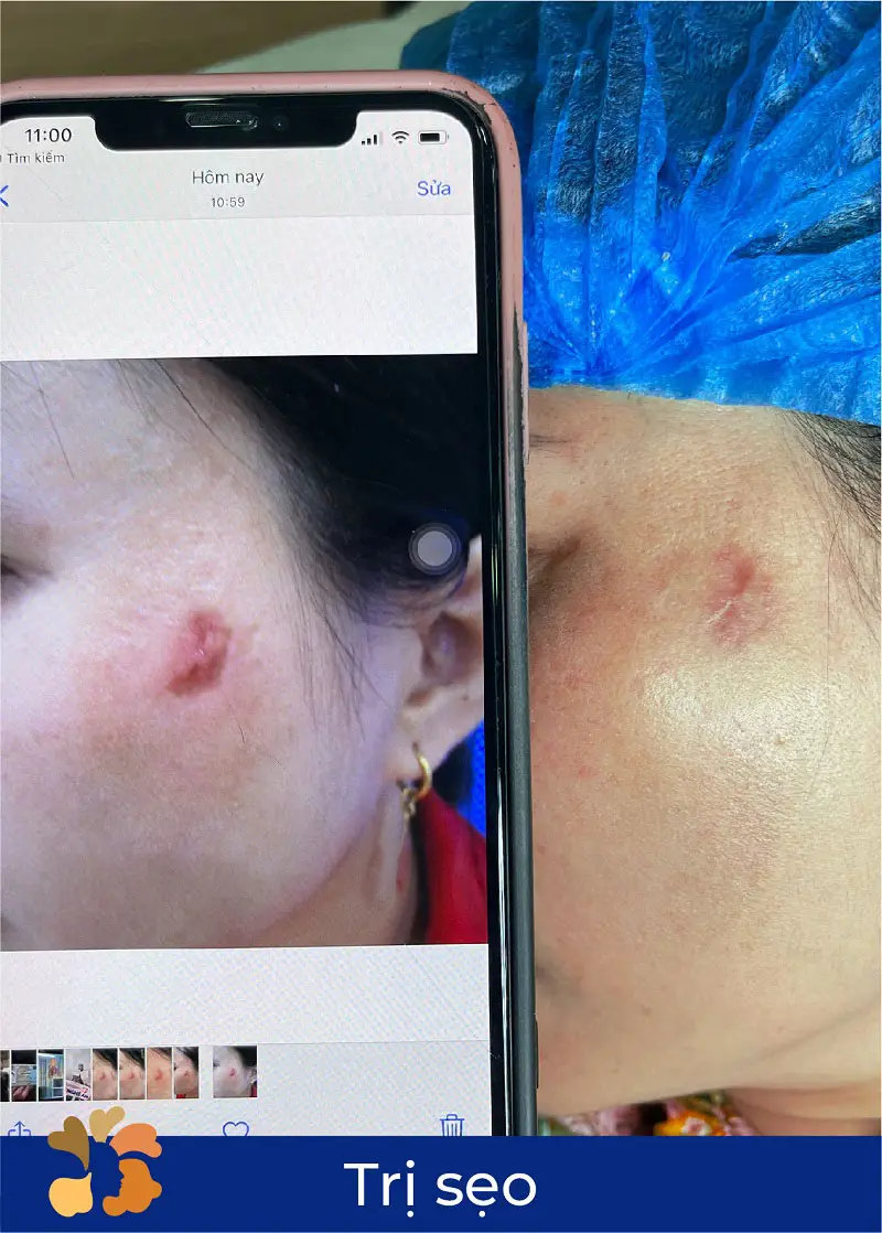 Laser CO2 Fractional mang lại hiệu quả trị sẹo lồi cao