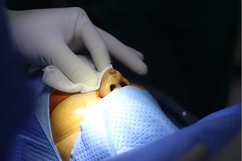 Tháo sụn mũi cấy trung bì mỡ áp dụng cho những trường hợp mũi bị viêm sau nâng mũi bằng chất liệu nhân tạo