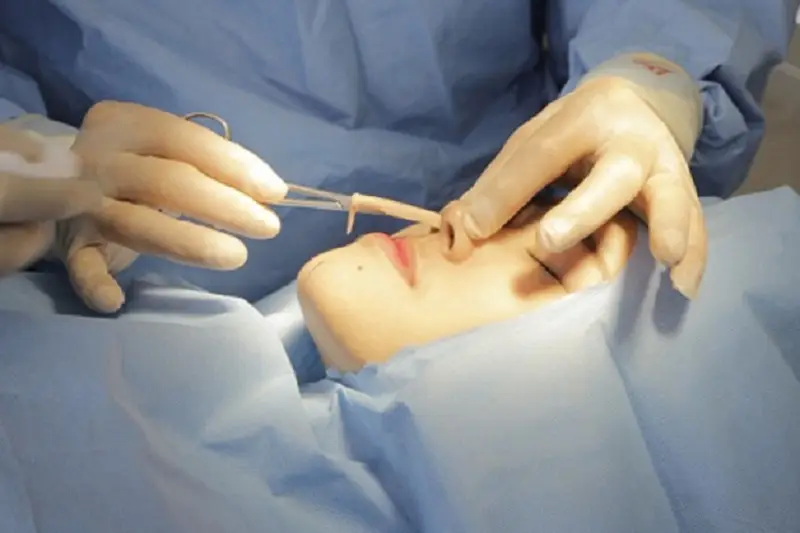 Sau khi tháo sụn mũi nên để vết thương ổn định