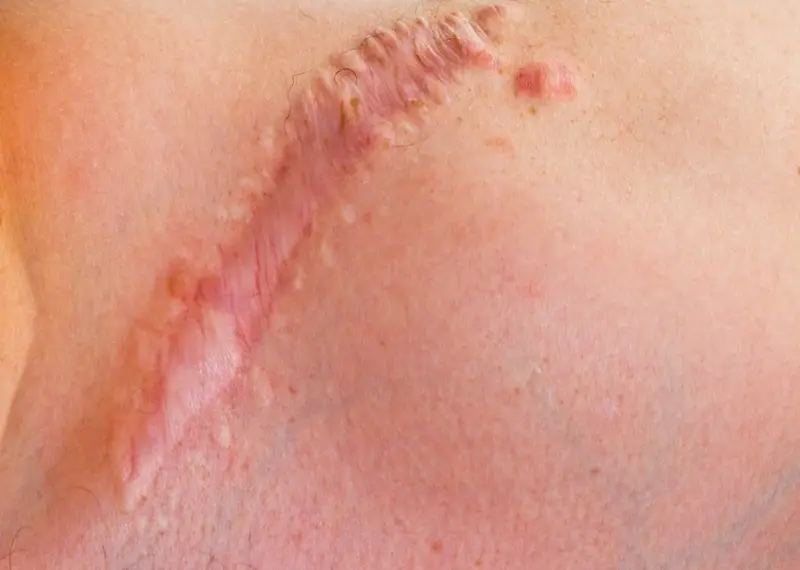 Vùng da trị sẹo lồi bị gặp tác dụng phụ, nổi nhiều mạch máu nhỏ