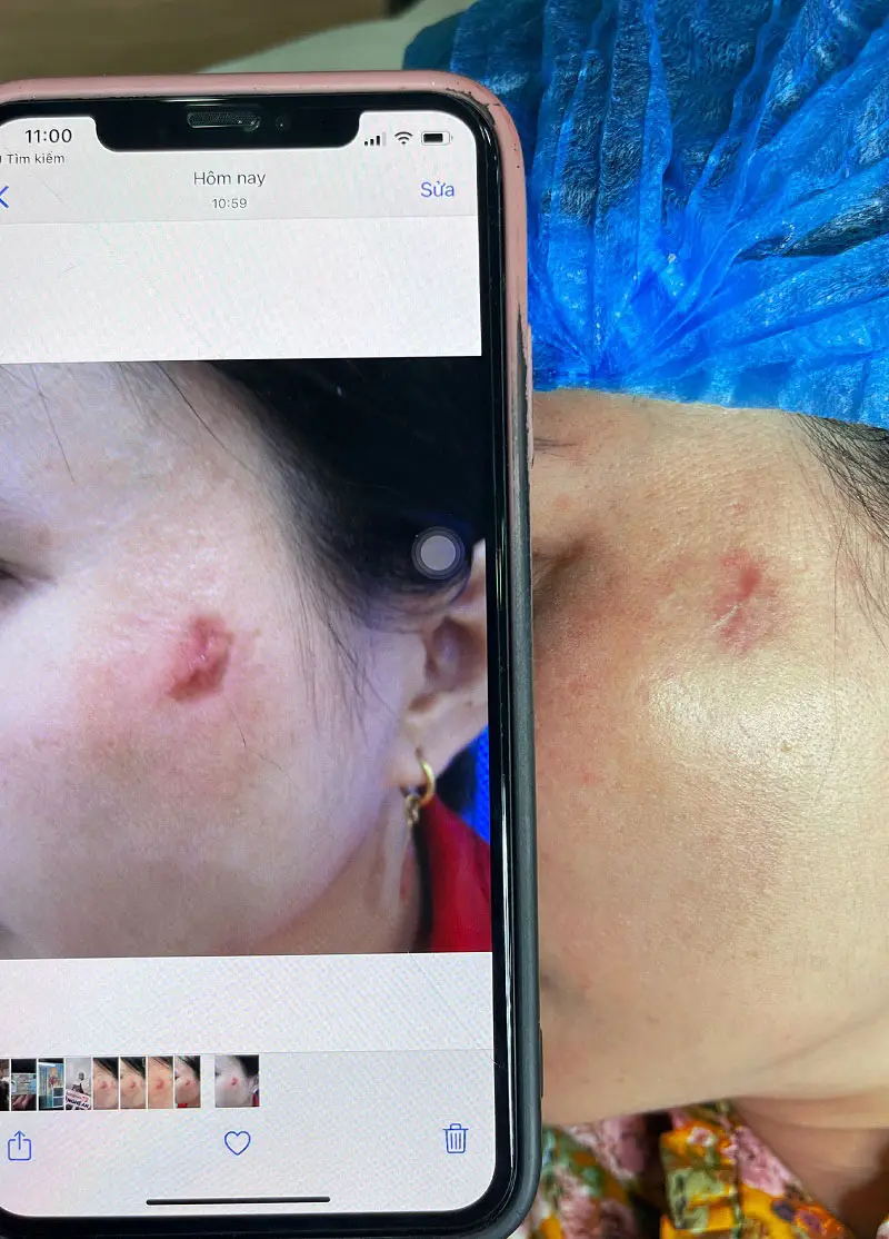 Diện tích sẹo lồi ảnh hưởng đến chi phí điều trị