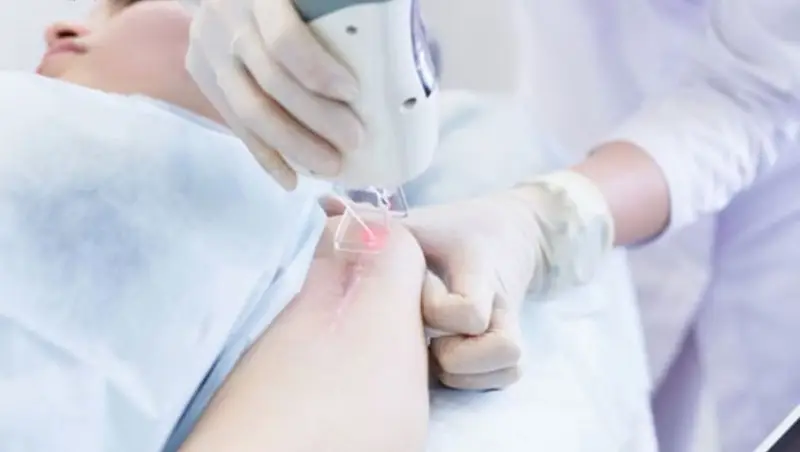 Kỹ thuật laser trị sẹo càng hiện đại thì chi phí điều trị sẽ càng cao