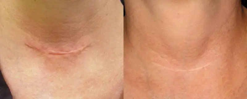 Vết sẹo lồi có thể giảm thiểu đáng kể