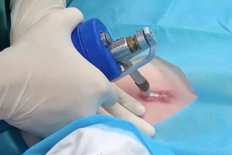 Tùy vào từng tình trạng sẹo lồi các bác sĩ ở Bệnh viện Da liễu Trung ương sẽ áp dụng phương pháp phù hợp