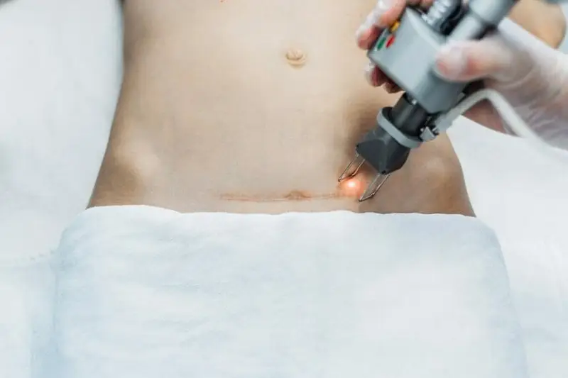 Tia laser được sử dụng phổ biến để loại bỏ sẹo lồi thâm đen