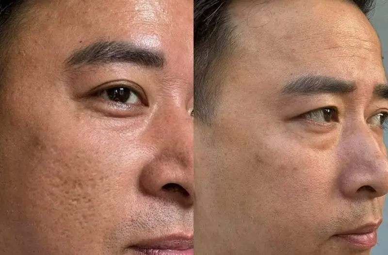 Khách hàng sau khi thực hiện liệu trình trị sẹo lõm bằng laser đã sở hữu khuôn mặt láng mịn hơn