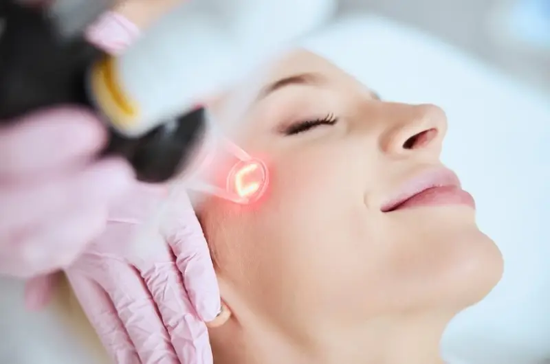 Trị sẹo lõm bằng laser mang lại hiệu quả điều trị cao