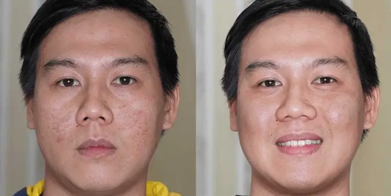 Với những trường gặp tình trạng vết sẹo lõm sâu sẽ có mức giá trị sẹo cao hơn