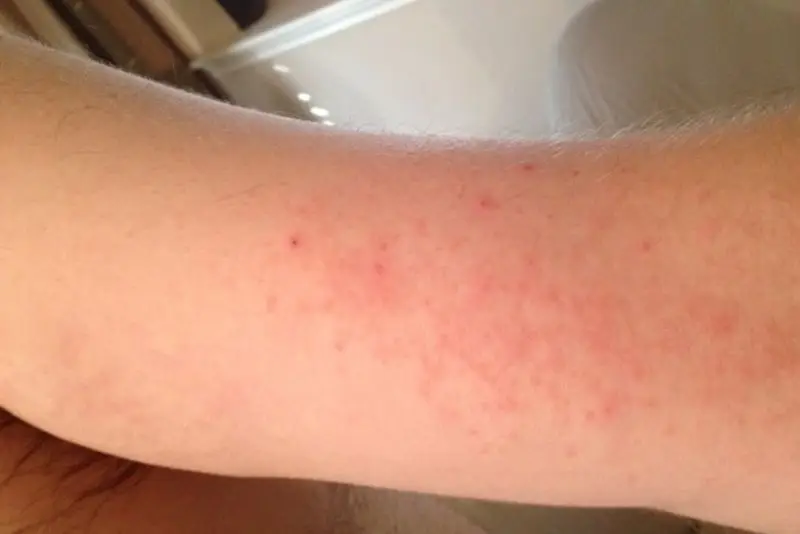 Ngứa sau triệt lông có thể do kích ứng nhiệt