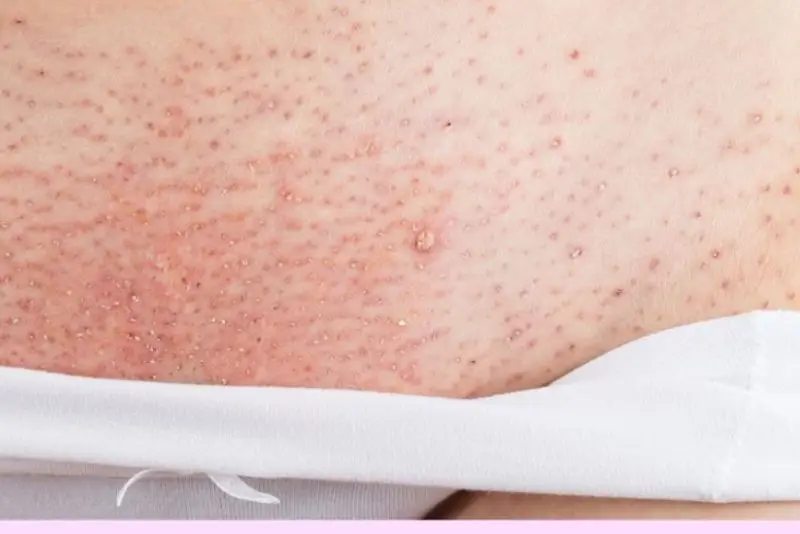 Mẩn đỏ do triệt lông sai kỹ thuật