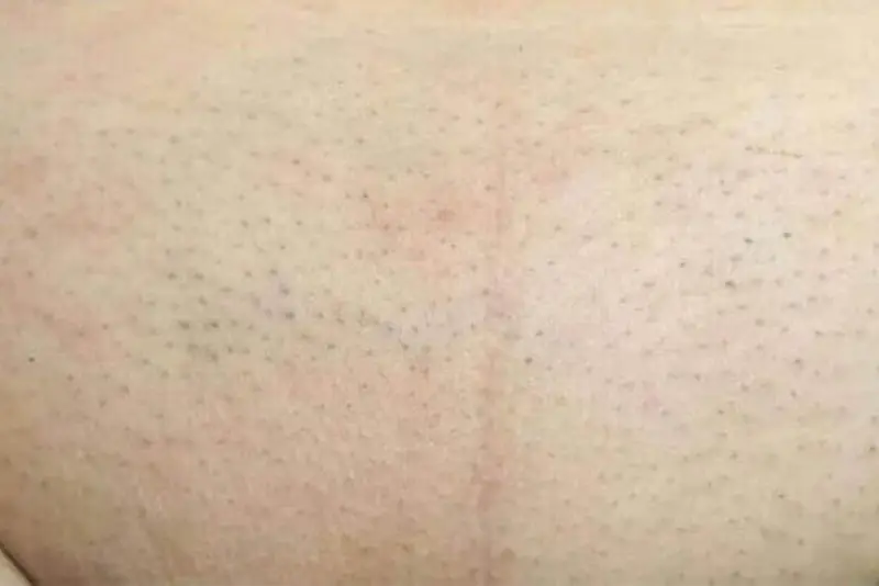 Nâng lông yếu dần sau mỗi lần triệt, làm giảm khả năng mọc lại của lông