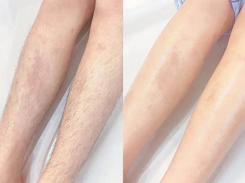 Triệt lông an toàn, hiệu quả