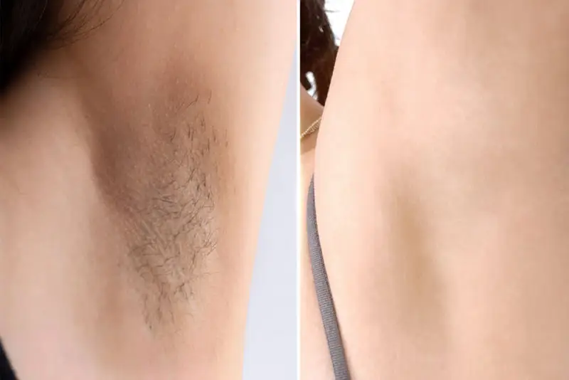Không còn lông mọc lại hoặc chỉ xuất hiện vài sợi lông tơ mảnh