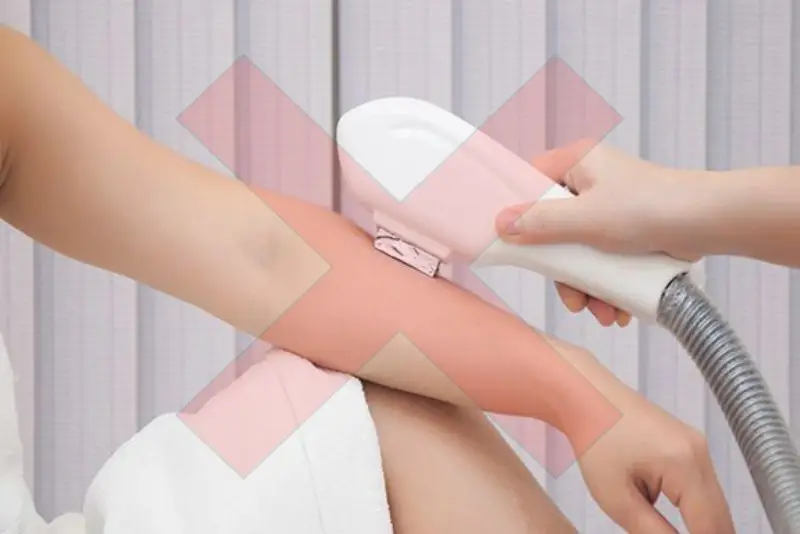 12 tuổi không nên triệt lông vĩnh viễn bằng công nghệ như laser hoặc IPL