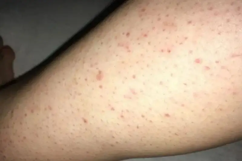 Triệt lông khi chưa đủ tuổi khiến da kích ứng