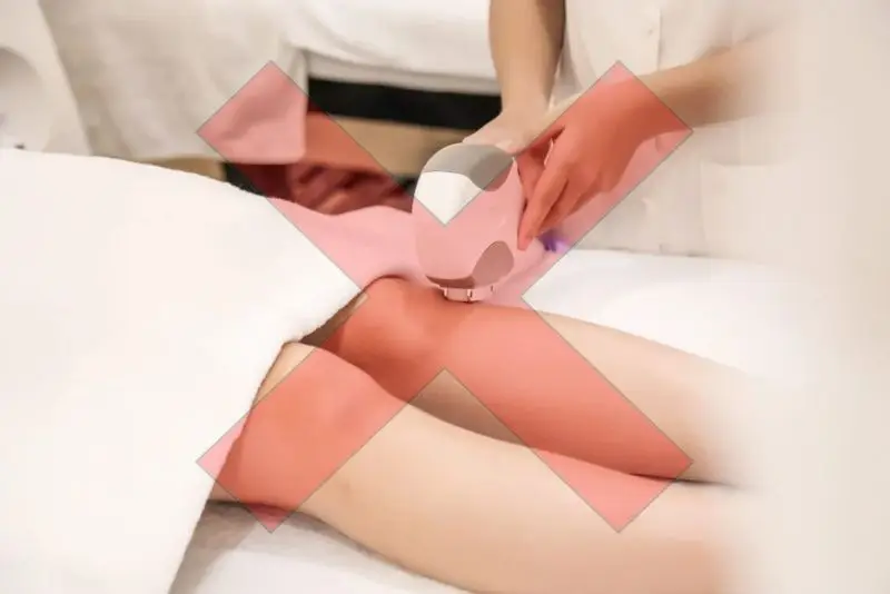 14 tuổi không nên triệt lông bằng laser hay IPL