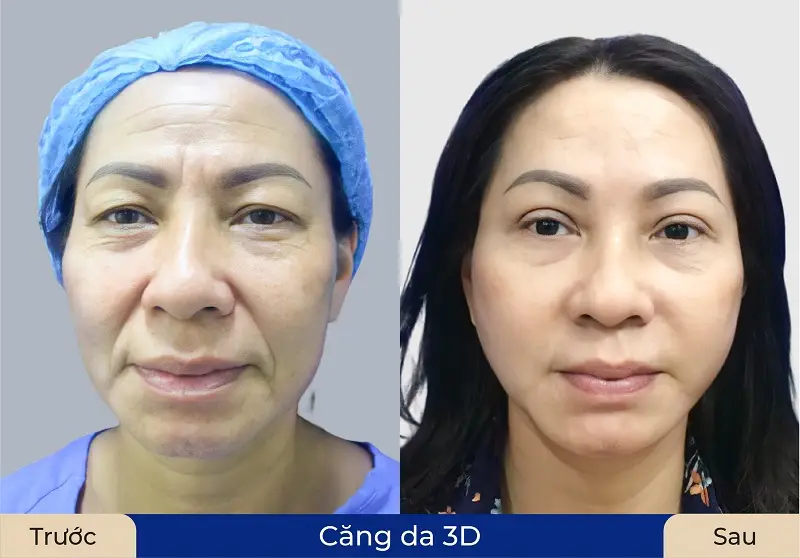 Phương pháp căng da mặt 3D giúp làn da căng mịn, khắc phục tình trạng chảy xệ