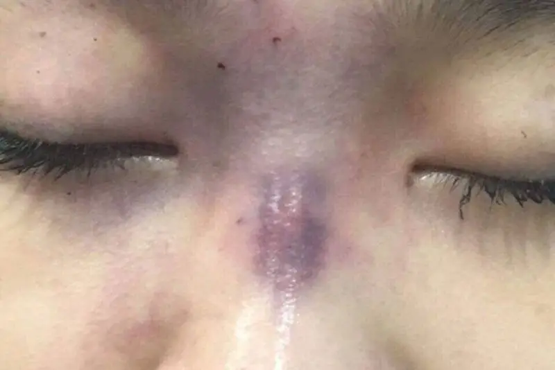 Hậu quả do tiêm filler khi chưa đủ tuổi