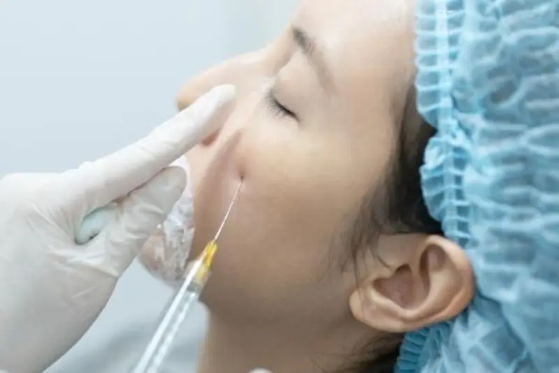 Chỉ nên tiêm filler khi đủ 18 tuổi