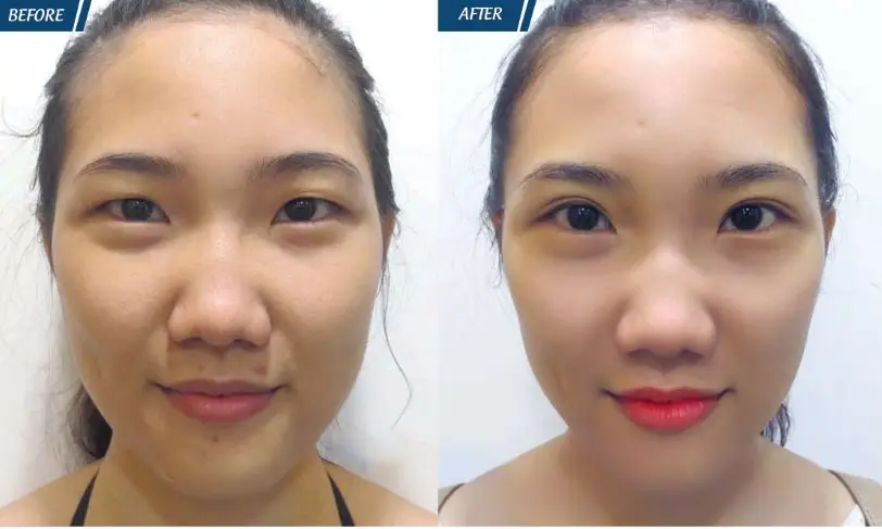 Chỉ nên nhấn mí sau khi đã sinh con và cơ thể ổn định