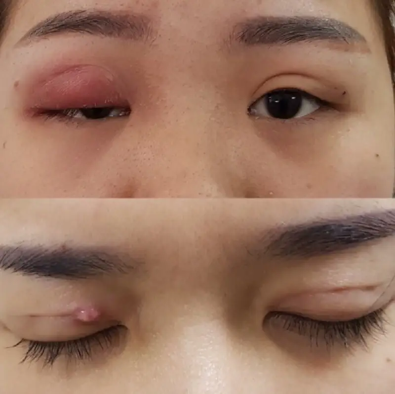 Mí mắt không đều, có u hạt là biến chứng nhấn mí có thể xảy ra