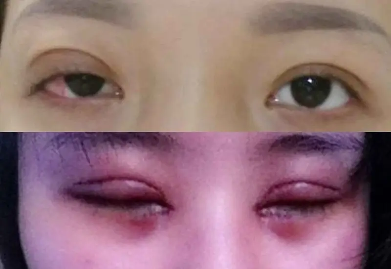 Mí mắt bị nhiễm trùng sau khi nhấn mí