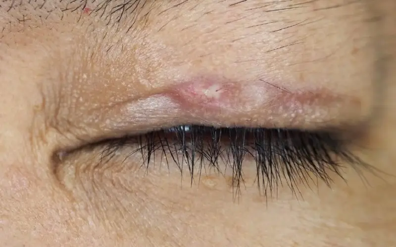 Để lại sẹo lồi sau khi nhấn mí không đúng kỹ thuật