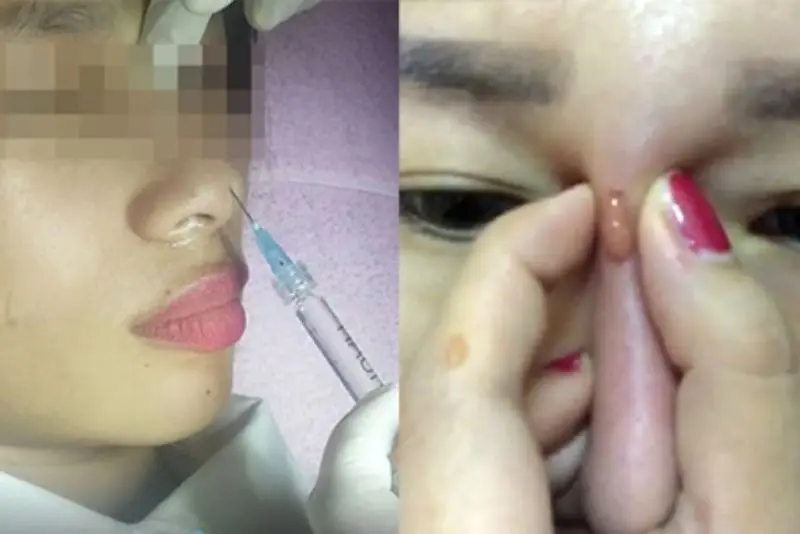 Nhiễm trùng sau tiêm filler