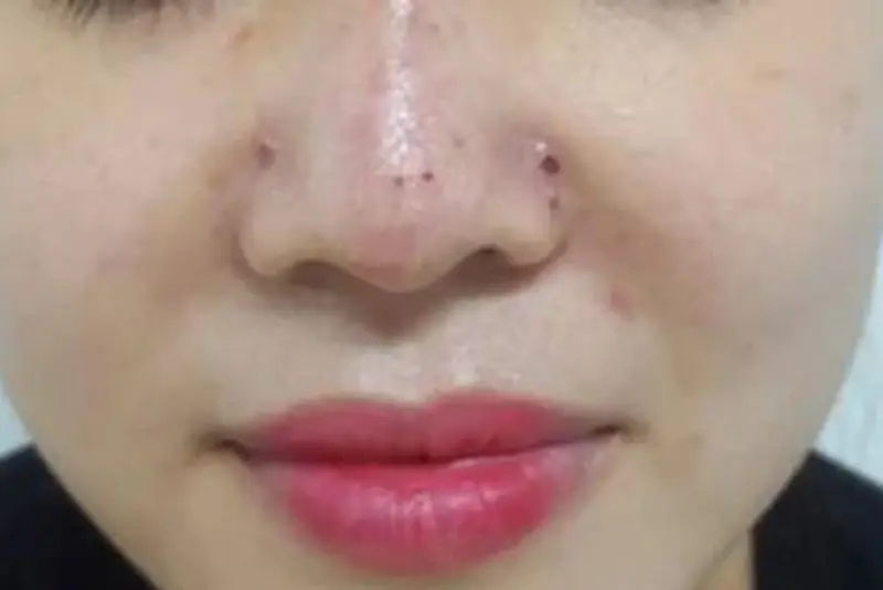 Biến chứng do tiêm filler sai kỹ thuật