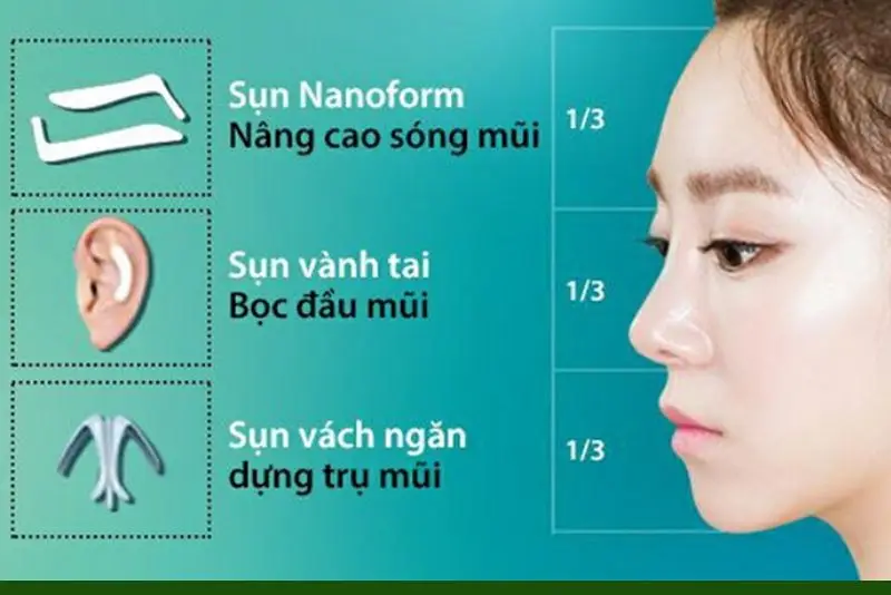 Nâng mũi cấu trúc 4D