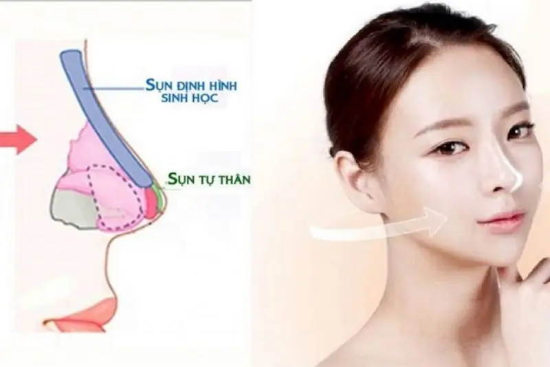 Nâng mũi bán cấu trúc
