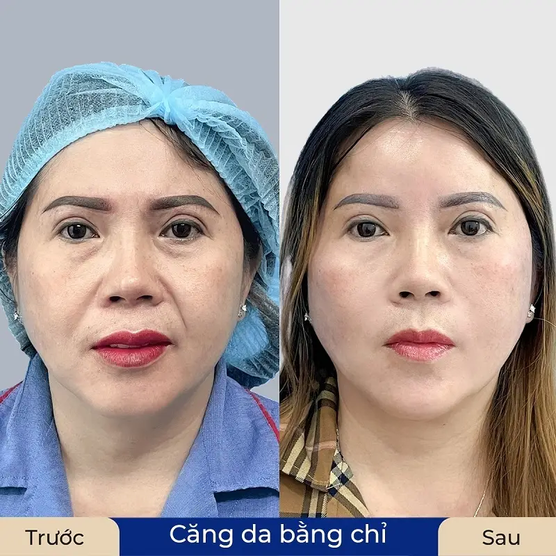 Căng chỉ collagen kích thích làn da mịn màng từ sâu bên trong