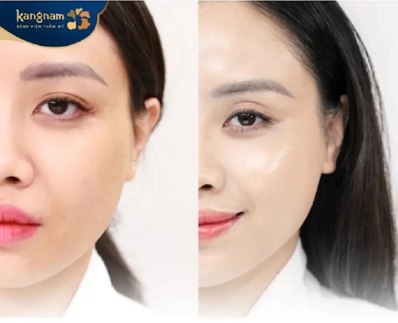 Căng bóng da mặt giúp làn da tươi trẻ, mịn màng hơn