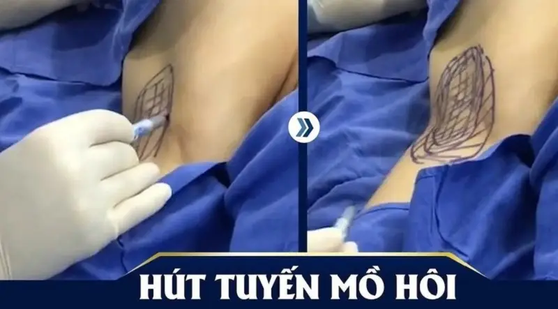 Hút tuyến mồ hôi nách không đau, không xâm lấn