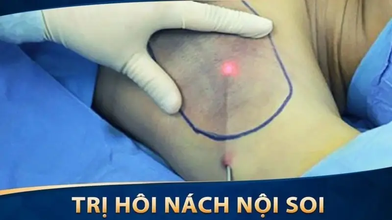 Trị hôi nách nội soi không xâm lấn, rút ngắn thời gian phục hồi