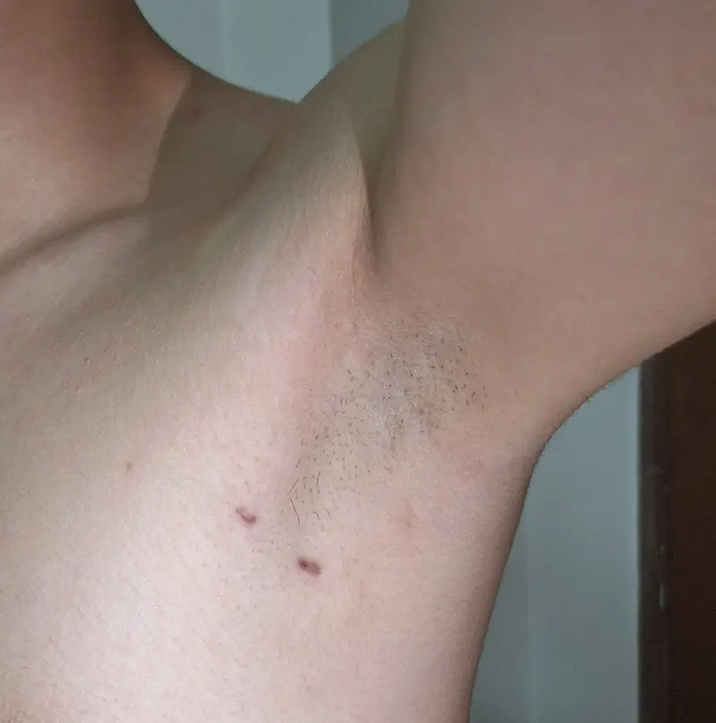 Vùng nách sáng mịn, đều màu hơn sau hút tuyến