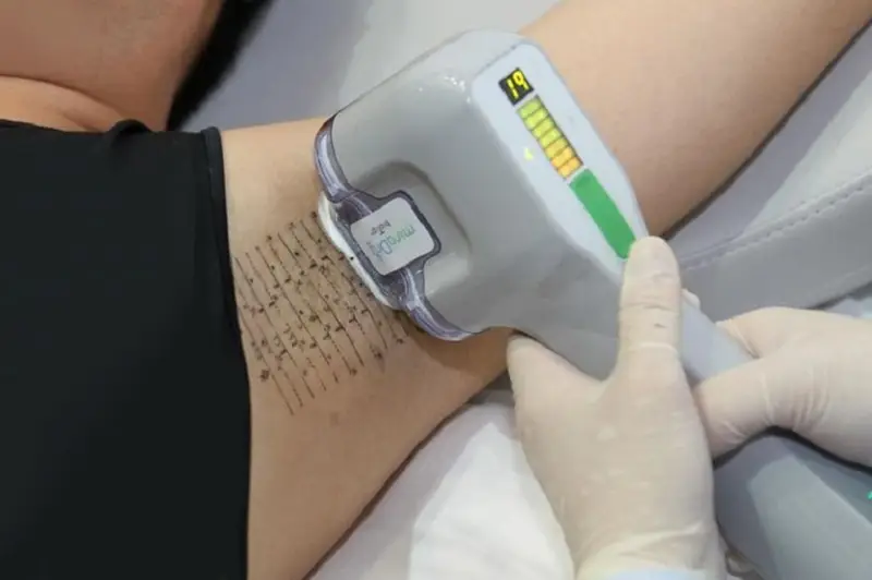 Cắt tuyến mồ hôi nách bằng laser giúp giảm thiểu mồ hôi nách