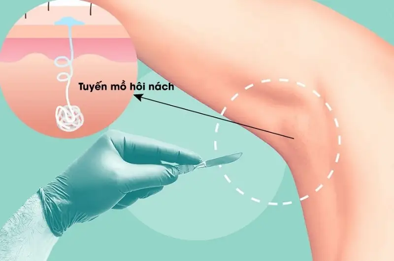 Cắt tuyến mồ hôi nách không gây tái phát lại