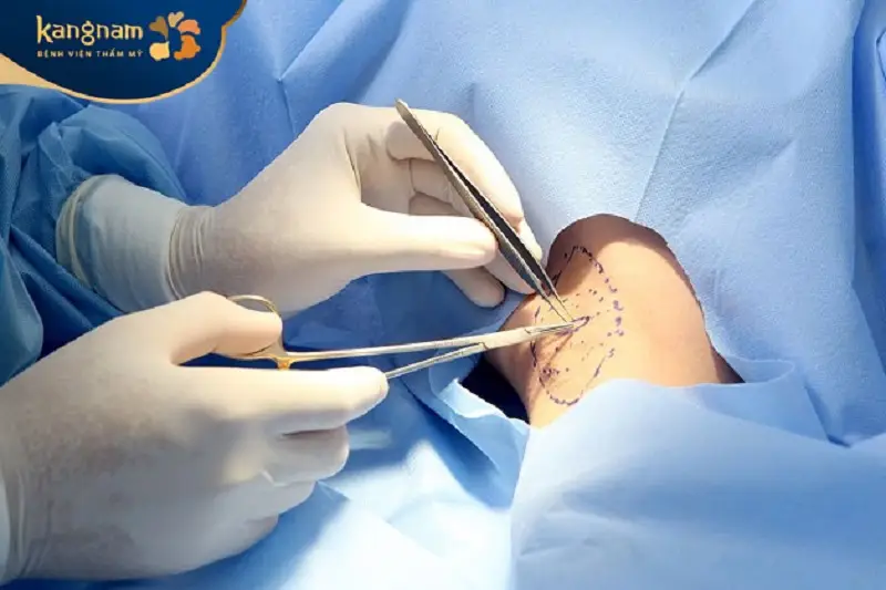 Công nghệ nội soi Endo Dry giúp loại bỏ mùi hôi nách triệt để