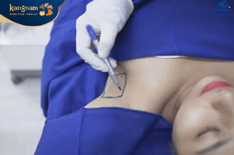 Cắt tuyến mồ hôi Endo Dry giúp loại bỏ tuyến mồ hôi nách an toàn