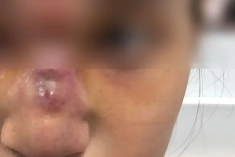 Mũi nhiễm trùng do biến chứng nâng mũi chỉ