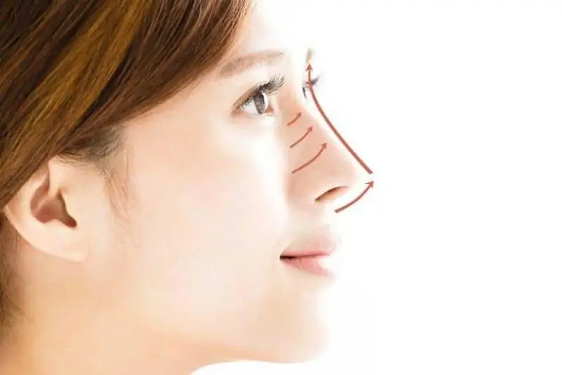 Nâng mũi bằng chỉ duy trì khoảng 1 năm
