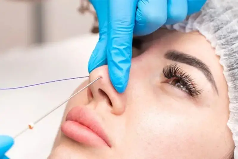 Nâng mũi bằng chỉ