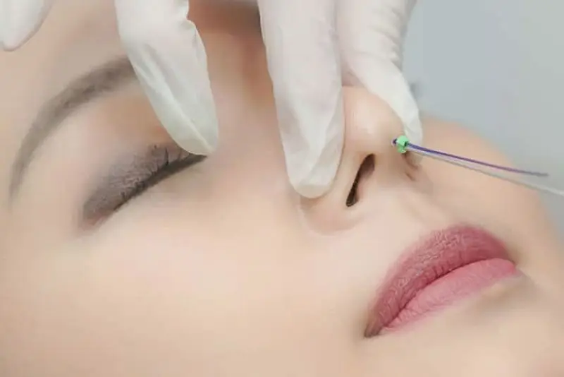 Nâng mũi chỉ Hiko có cấu trúc gai xoắn 360 độ giúp cố định và nâng đỡ mô mũi