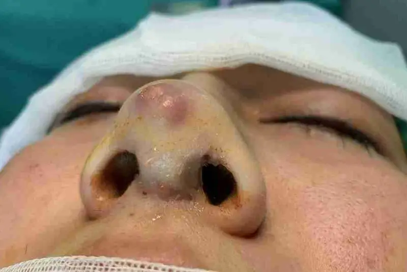 Lòi sụn mũi có thể gây đỏ da, căng tức và đau rát kéo dài